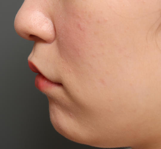 20代女性の人中短縮（リップリフト） After 症例写真