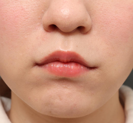 20代女性の唇・口元の整形 After 症例写真