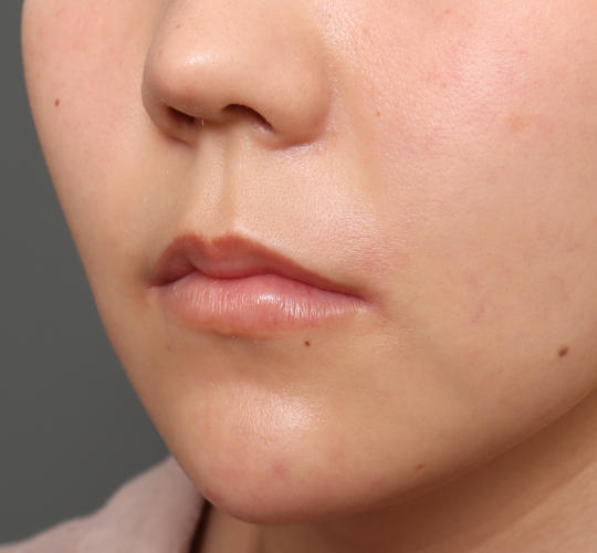20代女性の人中短縮(リップリフト) Before 症例写真