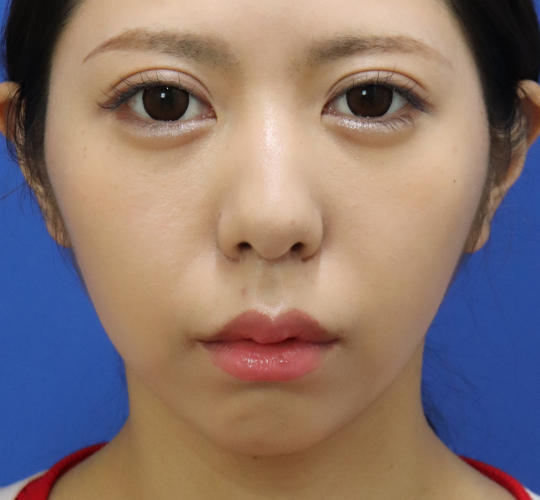 20代女性の唇・口元の整形 After 症例写真