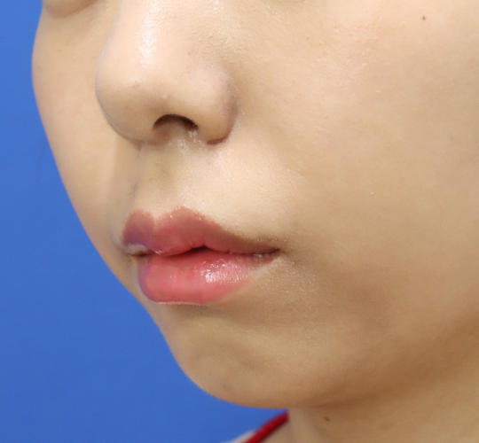 20代女性の人中短縮（リップリフト） After 症例写真