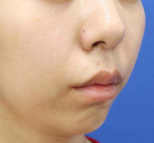 20代女性の人中短縮（リップリフト） After 症例写真