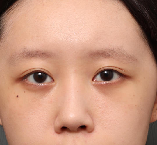 20代女性の3Dリポアイリフト  After 症例写真