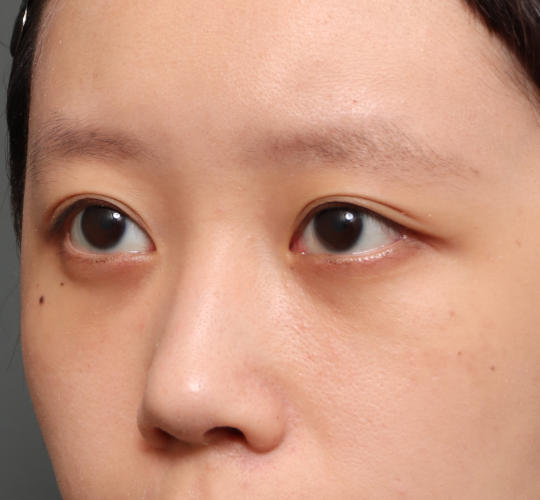 20代女性の3Dリポアイリフト  After 症例写真