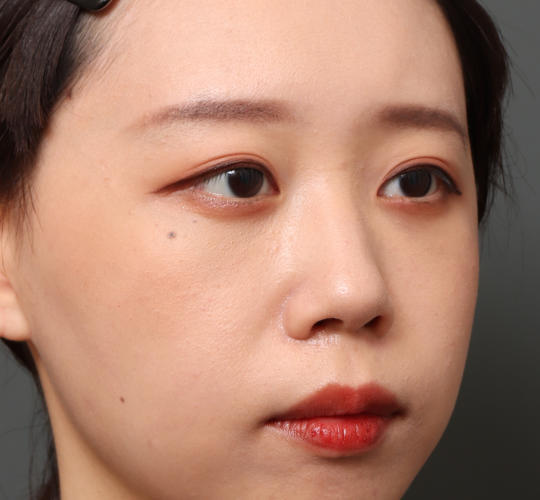 20代女性の目の下のクマ治療 After 症例写真