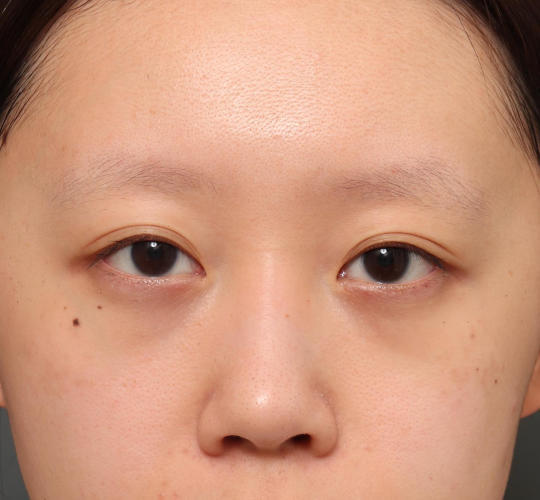 20代女性の3Dリポアイリフト  Before 症例写真