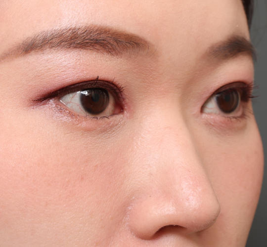 30代女性の目頭切開 After 症例写真