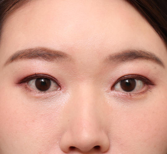 30代女性の二重整形・目元の整形 After 症例写真