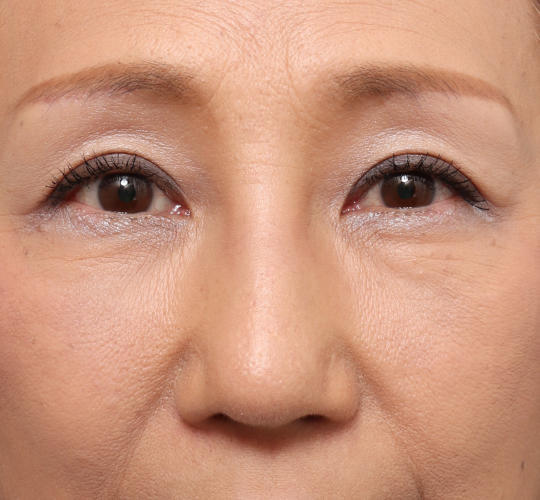 60代女性の鼻プロテーゼ After 症例写真