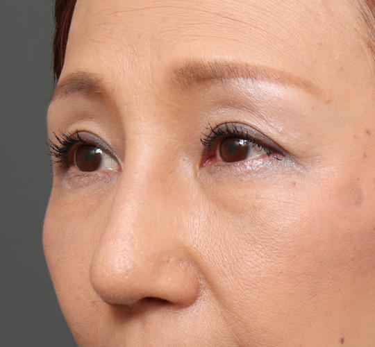 鼻整形の症例写真 公式 オザキクリニック 美容整形 美容外科 美容皮膚科 東京新宿 目黒祐天寺 羽村