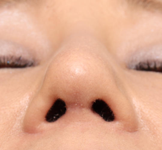 60代女性の鼻プロテーゼ After 症例写真