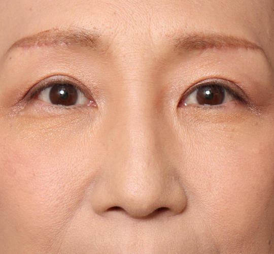 60代女性の鼻プロテーゼ Before 症例写真