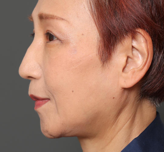 60代女性の鼻プロテーゼ Before 症例写真