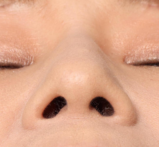 60代女性の鼻プロテーゼ Before 症例写真