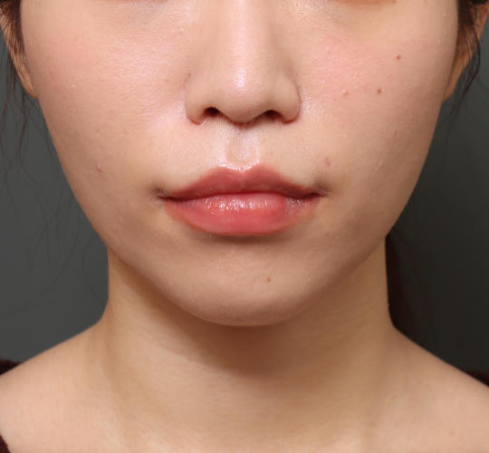 20代女性の人中短縮（リップリフト） After 症例写真