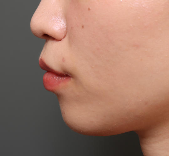 20代女性の人中短縮（リップリフト） After 症例写真