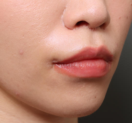 20代女性の人中短縮（リップリフト） After 症例写真