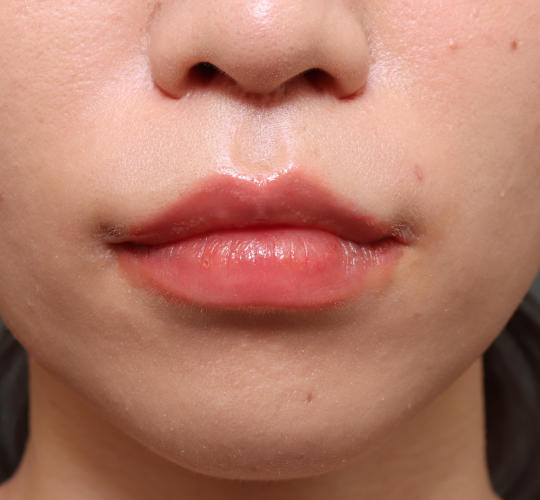 20代女性の人中短縮（リップリフト） After 症例写真