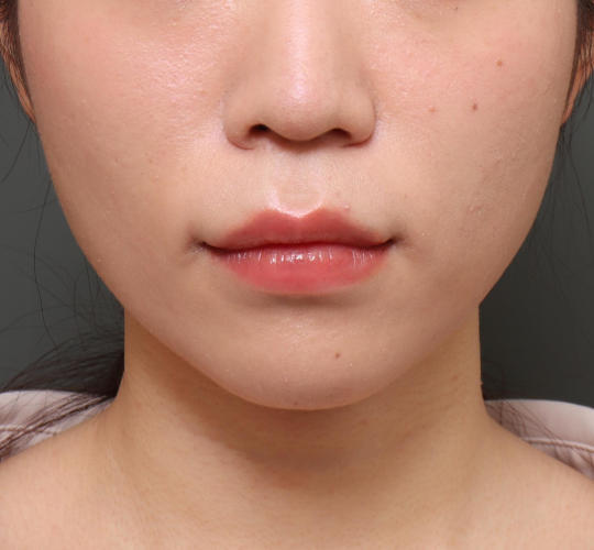 20代女性の人中短縮（リップリフト） Before 症例写真