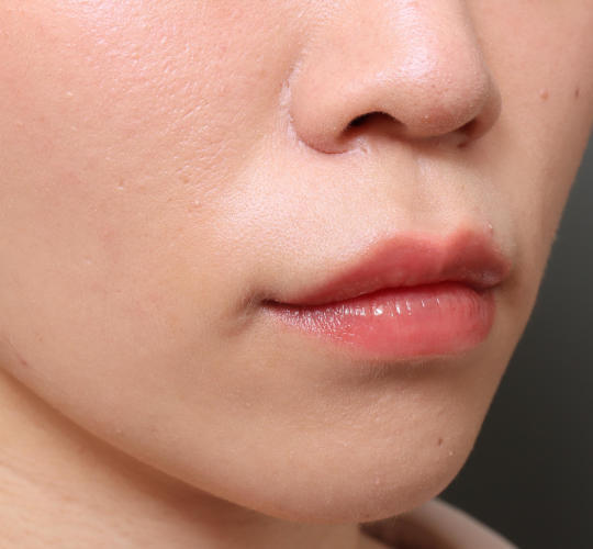 20代女性の人中短縮（リップリフト） Before 症例写真