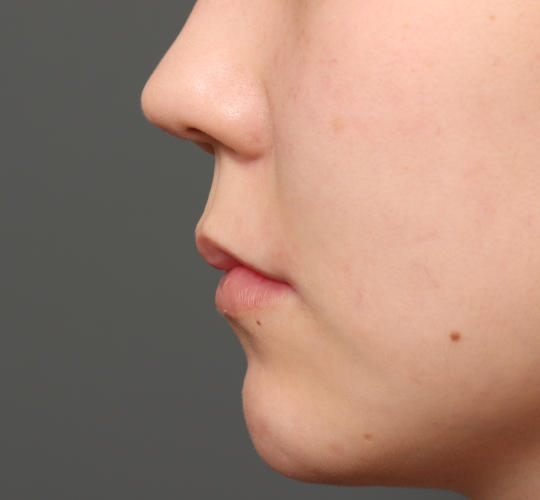 20代女性の人中短縮(リップリフト) Before 症例写真