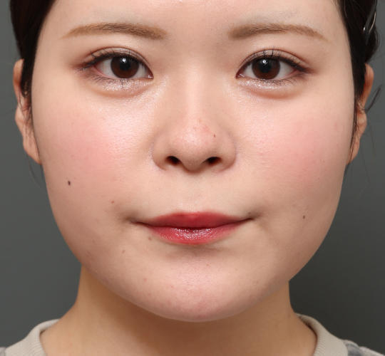 20代女性の人中短縮（リップリフト） Before 症例写真