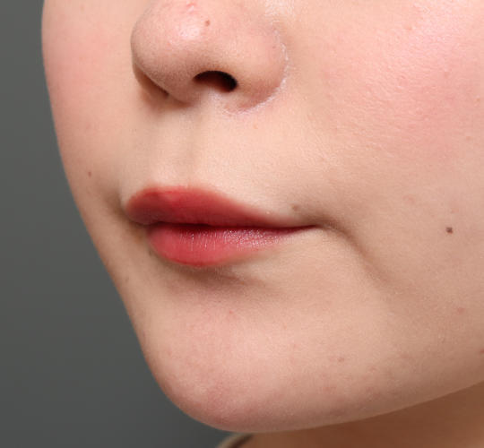 20代女性の人中短縮（リップリフト） Before 症例写真