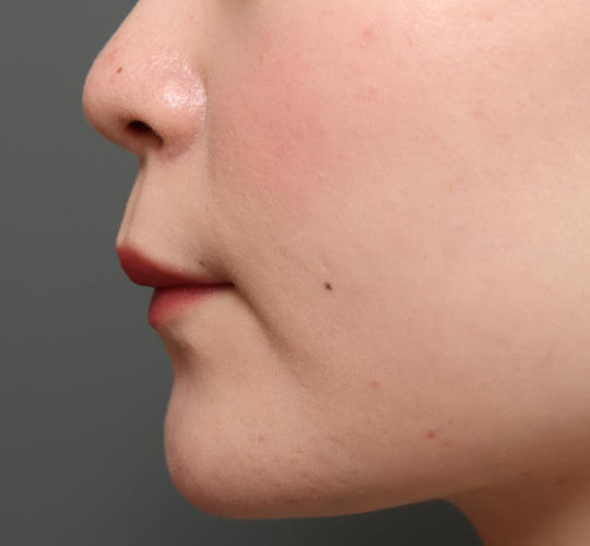 20代女性の人中短縮（リップリフト） Before 症例写真