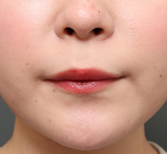 20代女性の人中短縮（リップリフト） Before 症例写真
