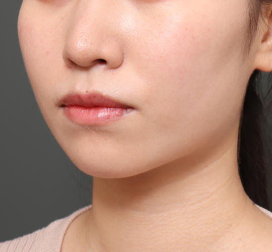 20代女性のエラ・アゴ・小顔 After 症例写真