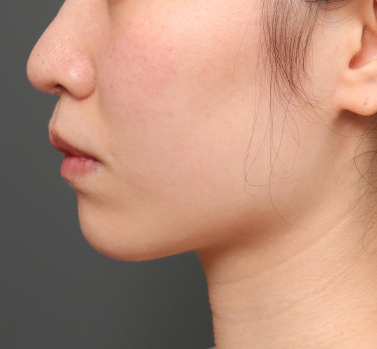 20代女性の顔の脂肪吸引  After 症例写真