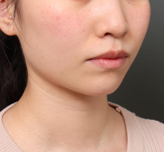 20代女性の顔の脂肪吸引  After 症例写真