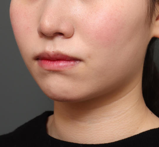 20代女性のエラ・アゴ・小顔 Before 症例写真