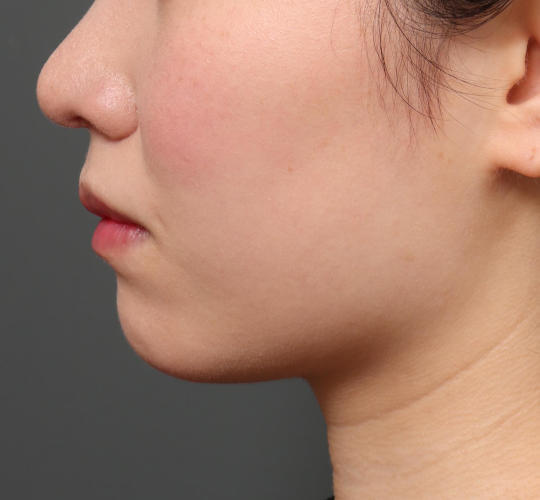 20代女性の顔の脂肪吸引  Before 症例写真