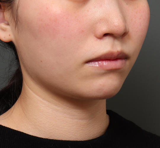 20代女性の顔の脂肪吸引  Before 症例写真