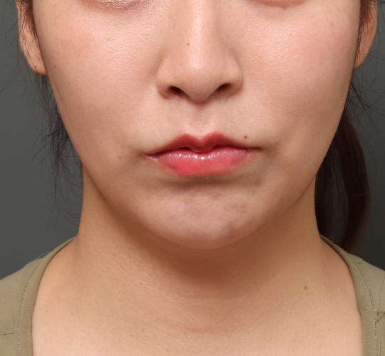 20代女性の鼻の整形 After 症例写真