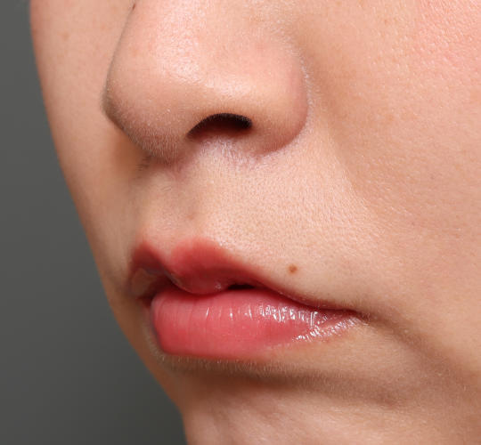 20代女性の人中短縮（リップリフト） After 症例写真