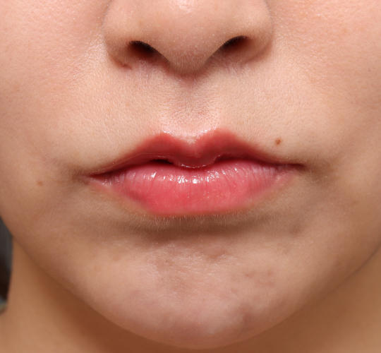 20代女性の人中短縮（リップリフト） After 症例写真