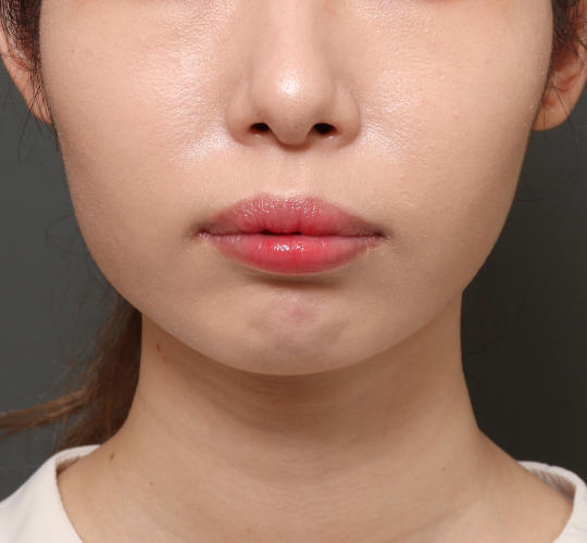 20代女性の顔の脂肪吸引  After 症例写真