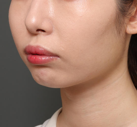 20代女性のシワ・たるみ After 症例写真