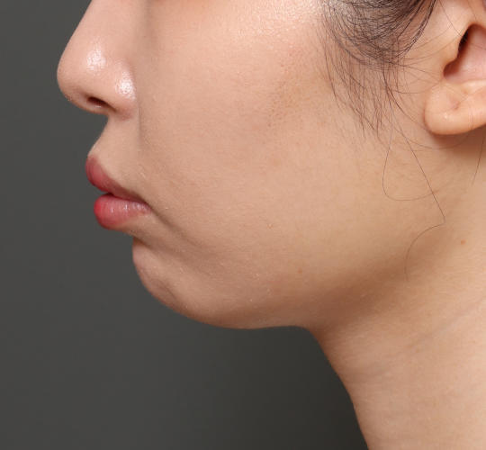 20代女性の顔の脂肪吸引  After 症例写真