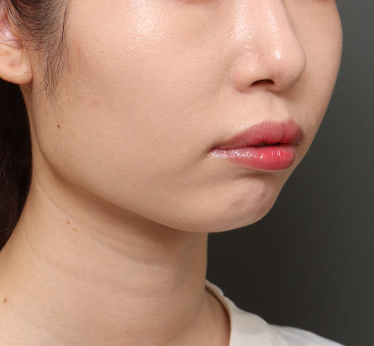 20代女性の顔の脂肪吸引  After 症例写真