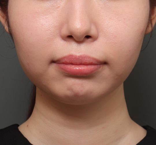 20代女性の顔の脂肪吸引  Before 症例写真