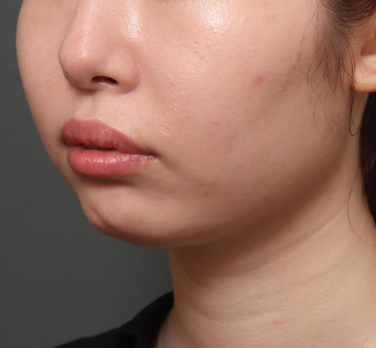 20代女性のシワ・たるみ Before 症例写真