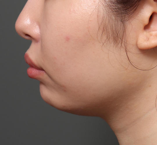 20代女性の顔の脂肪吸引  Before 症例写真