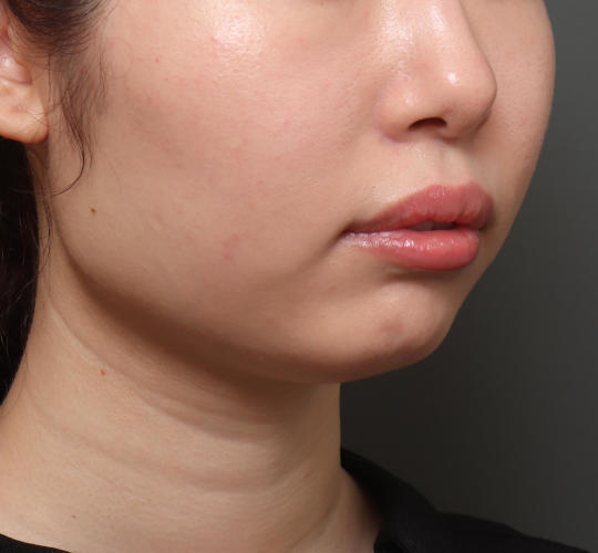 20代女性の顔の脂肪吸引  Before 症例写真