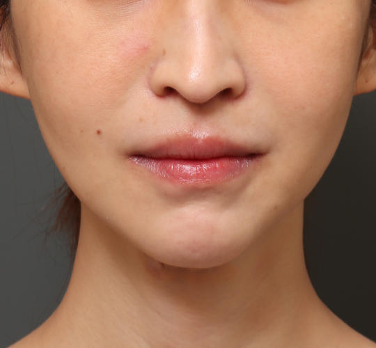 30代女性の唇・口元の整形 After 症例写真