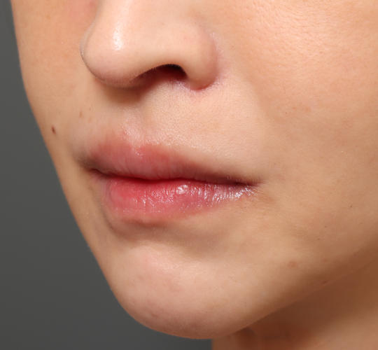 30代女性の人中短縮（リップリフト） After 症例写真
