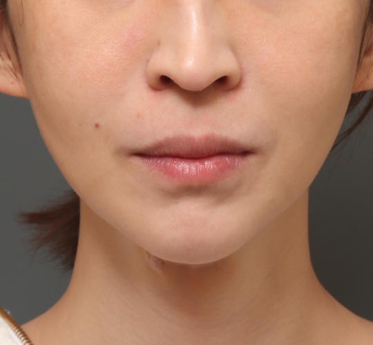 30代女性の唇・口元の整形 Before 症例写真