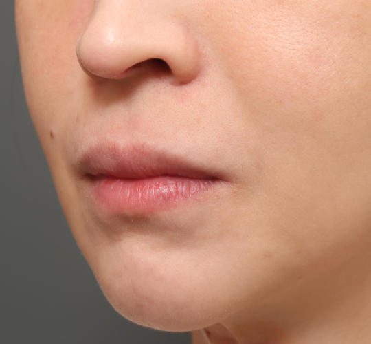 30代女性の人中短縮（リップリフト） Before 症例写真